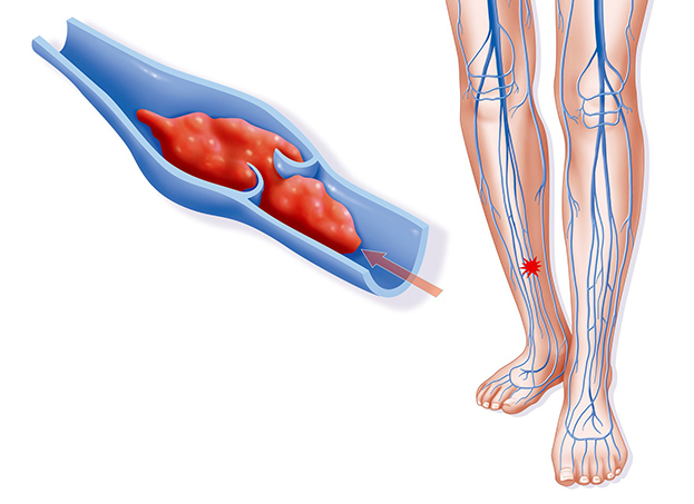 Тромбоз: 5 главных симптомов и чем он опасен