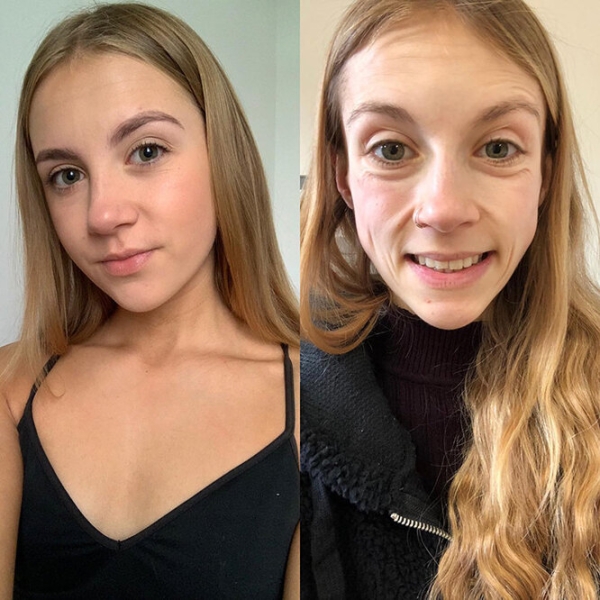 Эта девушка победила анорексию: посмотри, как изменились ее лицо и тело