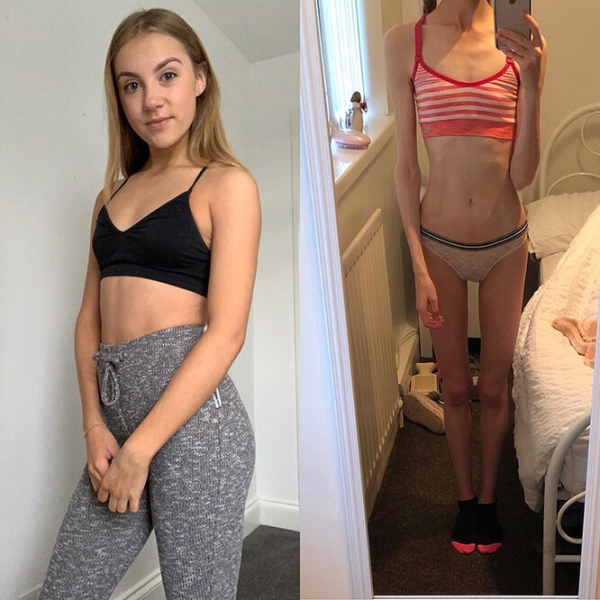 Эта девушка победила анорексию: посмотри, как изменились ее лицо и тело