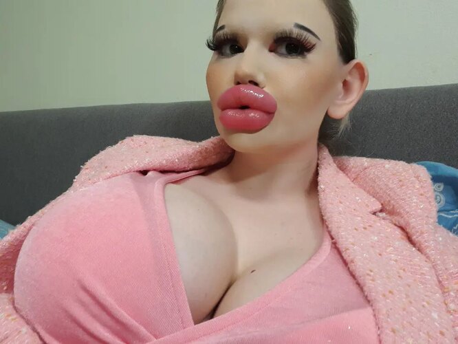 Как выглядит девушка с самыми большими губами в мире — врачи говорят, что она может из-за них умереть!