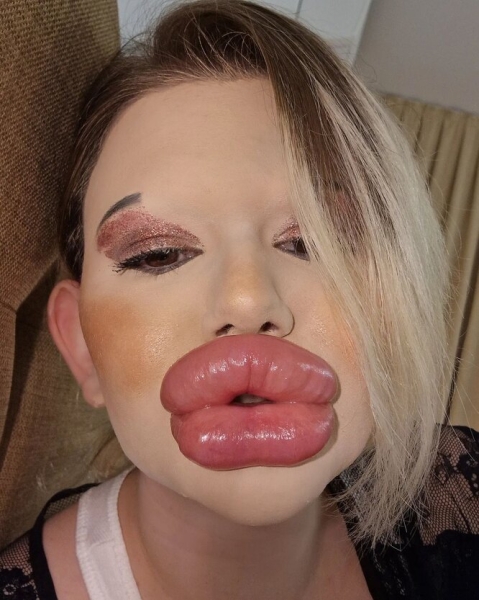 Как выглядит девушка с самыми большими губами в мире — врачи говорят, что она может из-за них умереть!