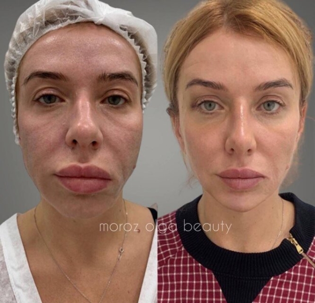 Стройное лицо за час: 5 шок-примеров полной трансформации после одного визита к косметологу