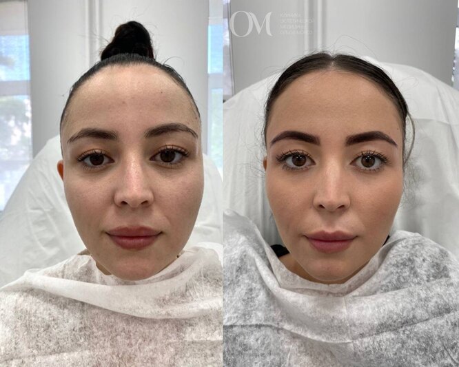 Стройное лицо за час: 5 шок-примеров полной трансформации после одного визита к косметологу