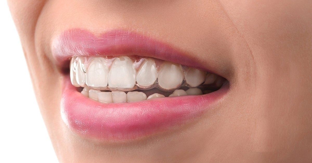 Как выглядят элайнеры на зубах?