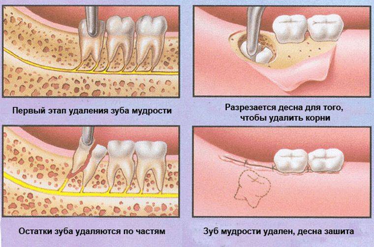 Методы удаления зубов мудрости