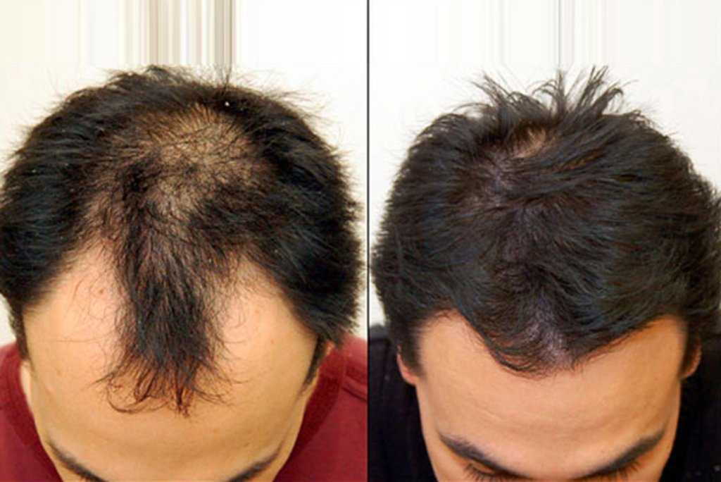Причины и симптомы выпадения волос: лечение заболевания
