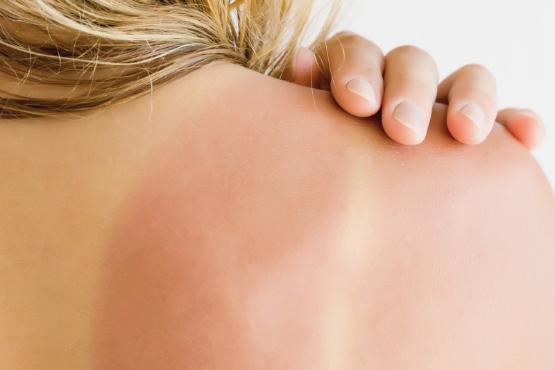 Аллергия на солнце: как она выглядит и что с ней делать
