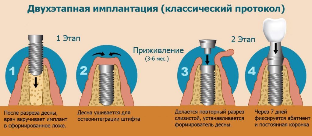 Показания и подготовка к протезированию зубов