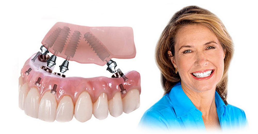 Имплантация всей челюсти: революционный подход к зубопротезированию