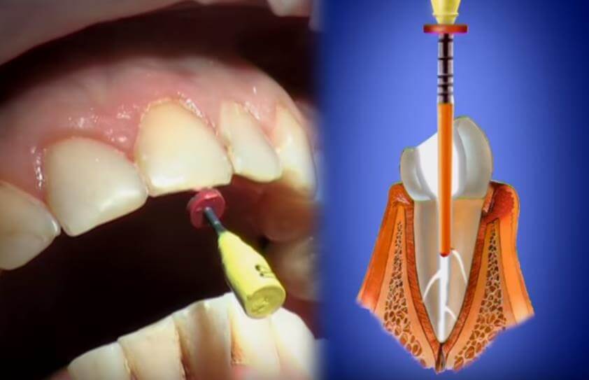 Термофильное пломбирование зубных каналов