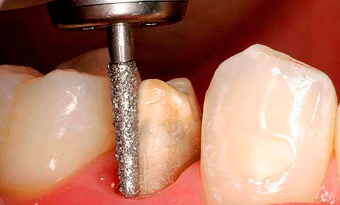 Процесс подготовки зуба к установке коронки: этапы и рекомендации