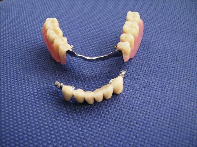 Мосты и коронки: особенности, преимущества и недостатки различных типов зубных протезов