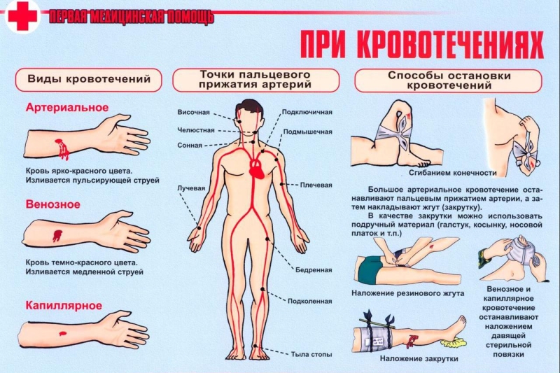 Как остановить кровь: капиллярное, артериальное, венозное кровотечение